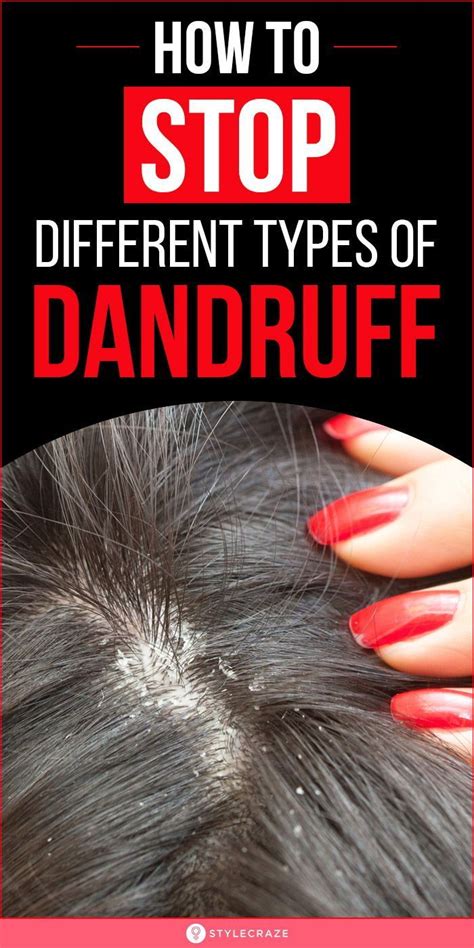 Different Types Of Dandruff And How To Stop Them In 2021 Natural Skin