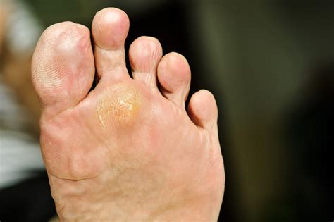 Calluses Symptoms Causes And Treatment By Fhp Group
