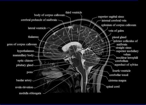 Sagittal Cross Sectional Anatomy Mri Brain 12 800×578 Mri Brain