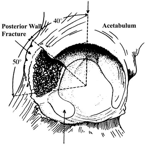 Illustration Of The Simulated Posterior Wall Fracture Of The