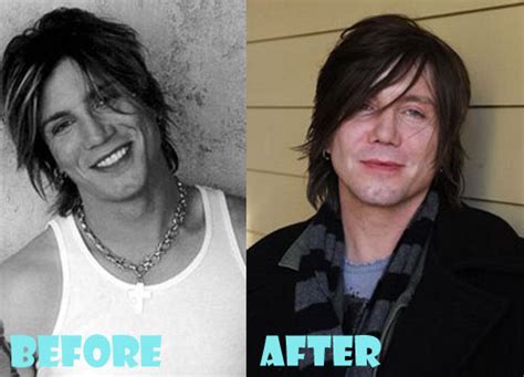 John Rzeznik Plastic Surgery Before and After Picture - Lovely Surgery