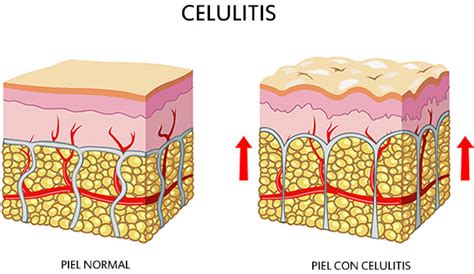 Celulitis Causas Tipos Y Prevención