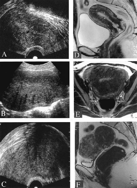 Sagittal Transvaginal Sonography Demonstrates Myometrial Anechoic