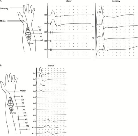 Long And Short Of Nerve Conduction Measures Reproducibility For