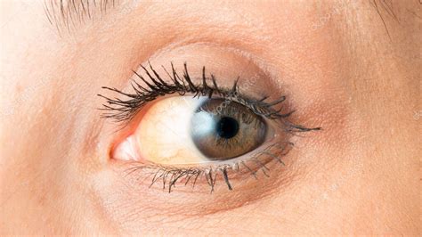 ojo con ictericia que muestra coloración amarillenta de la esclerótica 2023