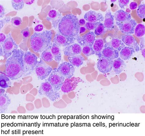 Pathology Outlines Plasma Cell Myeloma Multiple Myeloma