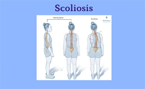 Scoliosis Types Causes Symptoms And Treatment Dubai Uae Westminster Ortho Med Clinic