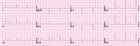 Dr Smith S ECG Blog Wellens Syndrome No Culprit What Happened