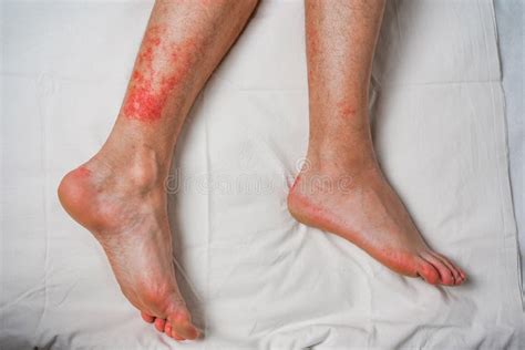 Rash Caused By Skin Allergic To Sweat Dust And Viruses Stock Image