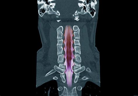 Neck Bones And Spinal Cord Photograph By Zephyrscience Photo Library