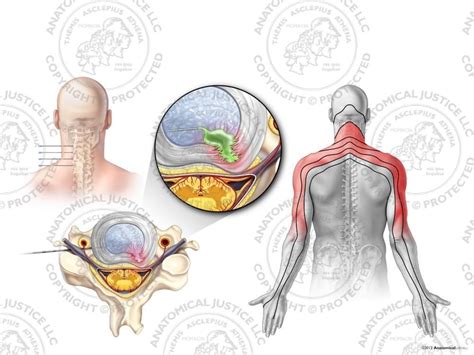 Male Left Cervical Discogram With Concordant Pain At C3 7 No Text