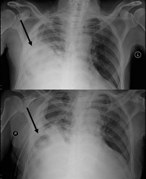 Chest X Ray Pre Left And Post Right Chest Tube Placement Shows