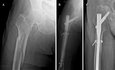 Past And Present Of The Use Of Cerclage Wires In Orthopedics Springerlink