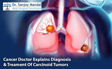 cancer doctor explains diagnosis and treament of carcinoid tumors