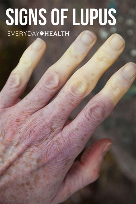 Lupus Symptoms Hands