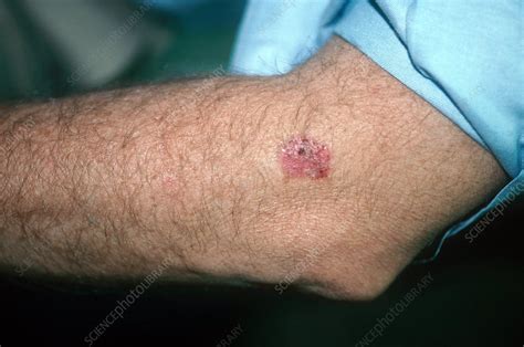 Basal Cell Carcinoma On Arm Stock Image C0222111 Science Photo
