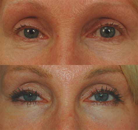 Weil Dankbar Kontaminieren Laser For Under Eye Wrinkles Vermehren Leder