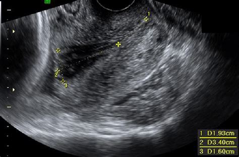 Real Transvaginal Ultrasound Of The Cervix With Funnelingfunctional