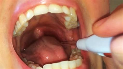Early Tonsil Stones Tonsil Stones Removal Tips