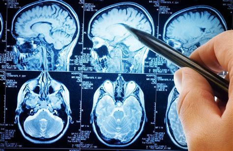 Early Warning Signs And Treatments Of Brain Cancer Howstuffworks