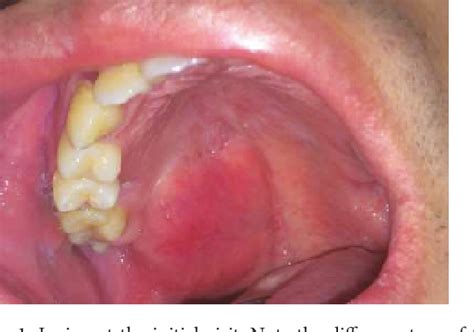 Figure 1 From An Unusual Variant Of A Common Palatal Salivary Gland