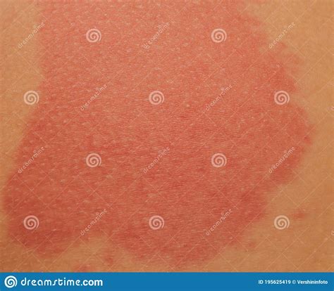 Urticaria Or Hives On The Back On The Shoulder Red Rashes Itchy Bumps