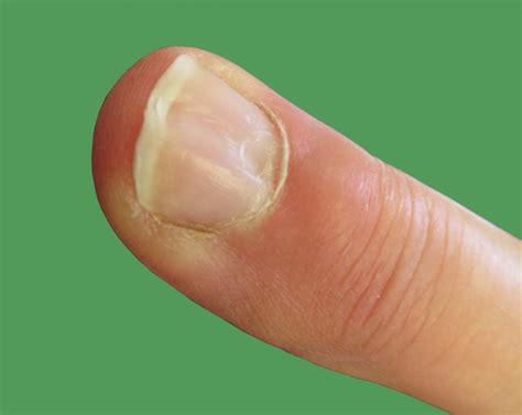Mucous Cysts Aberdeen Virtual Hand Clinic