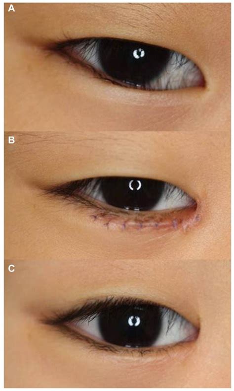 Epicanthal Folds Vs Normal Eye News Word