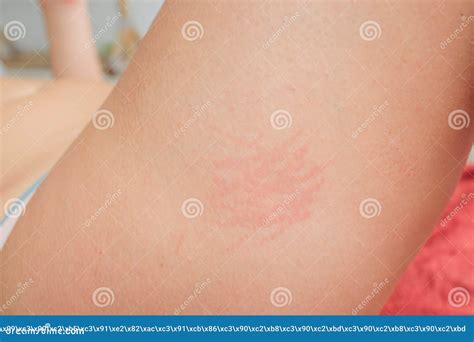 What Does A Gluten Skin Rash Look Like Severe Side Effects