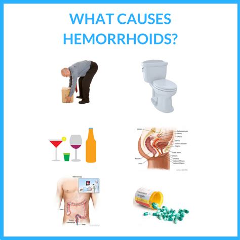 Hemorrhoid Causes Guide 101 Discover What Causes Hemorrhoids And How You Can Stop Them