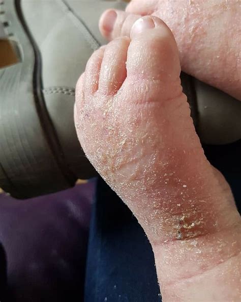 Eczema Treatment Baby Whose Feet Tore When He Tried To Walk Cleared