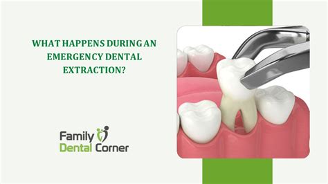 Ppt What Happens During An Emergency Dental Extraction Powerpoint