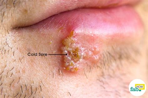 How to heal scabs fast. How to Get Rid of a Cold Sore Overnight | Fab How