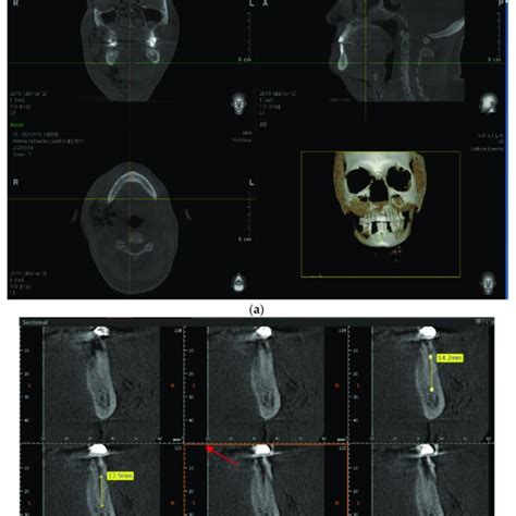 Cone Beam Computed Tomography Cbct Images A Air Infiltration Is