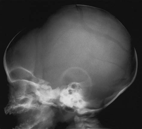 X Ray Skull Fracture
