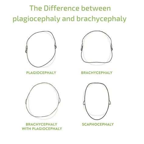 Curious About The Difference Between Plagiocephaly And Brachycephaly