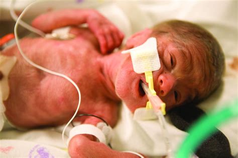 Extremely Preterm Infants Fare Better With Corticosteroid And Magnesium