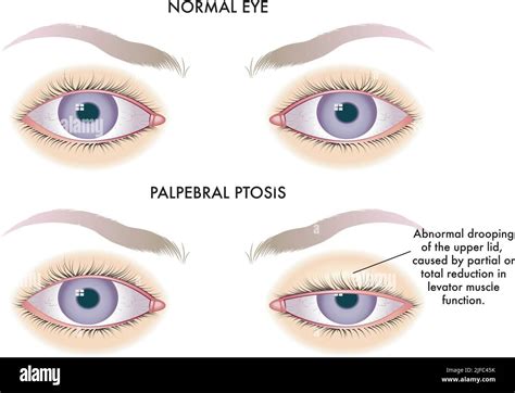 medical illustration shows the comparison between a normal eye and one affected by palpebral