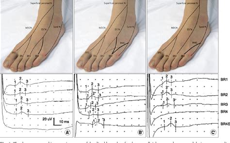 Table From Nerve Conduction Study Of The Superficial Peroneal Sensory