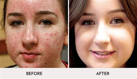 Laser Treatment For Acne And Scar Removal Spa Radiance Medical