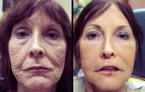 Find Out The Before After Photos Anti Bruising Juvederm Microcannula At