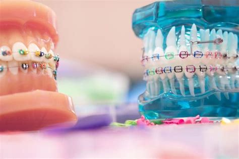 how to choose the best braces colors superior care orthodonticsorthodontist tulsa ok