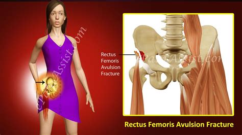 Hip Flexor Stretches Rectus Femoris Avulsion Fracture