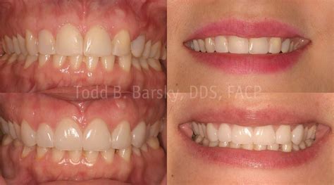Cosmetic Dentistry And Complete Smile Makeovers In Miami Barsky Dds