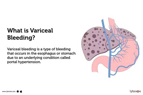 Variceal Bleeding Causes Symptoms Treatment And Cost