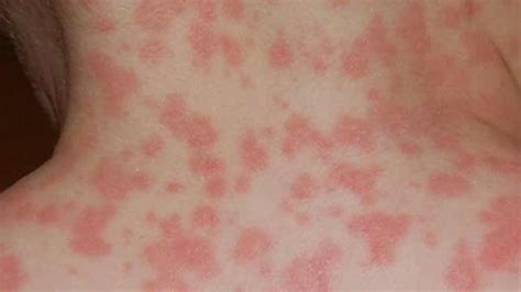 Amoxicillin Rash How To Identify And Treat