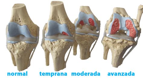 La Artrosis S Ntomas Y Prevenci N Mente Cuerpo Sano The Best