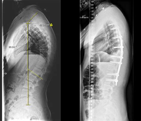 Kyphosis Johns Hopkins Medicine