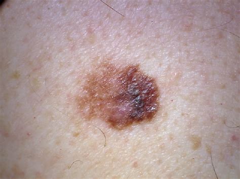 Many deaths occur in young adults. Can Itching Be the ONLY Symptom of Melanoma? » Scary Symptoms