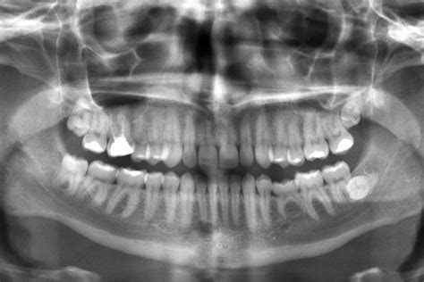 What You Should Know About Dental X Rays Nicole Mermet Dmd Dentist